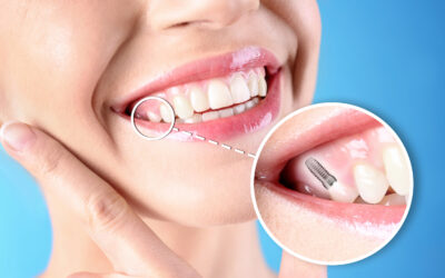 Implants 101: What a Dental Implant Is and Who It Suits