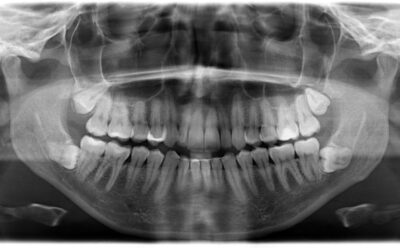 Dental X-Rays: Are They Safe? What We Use Them For
