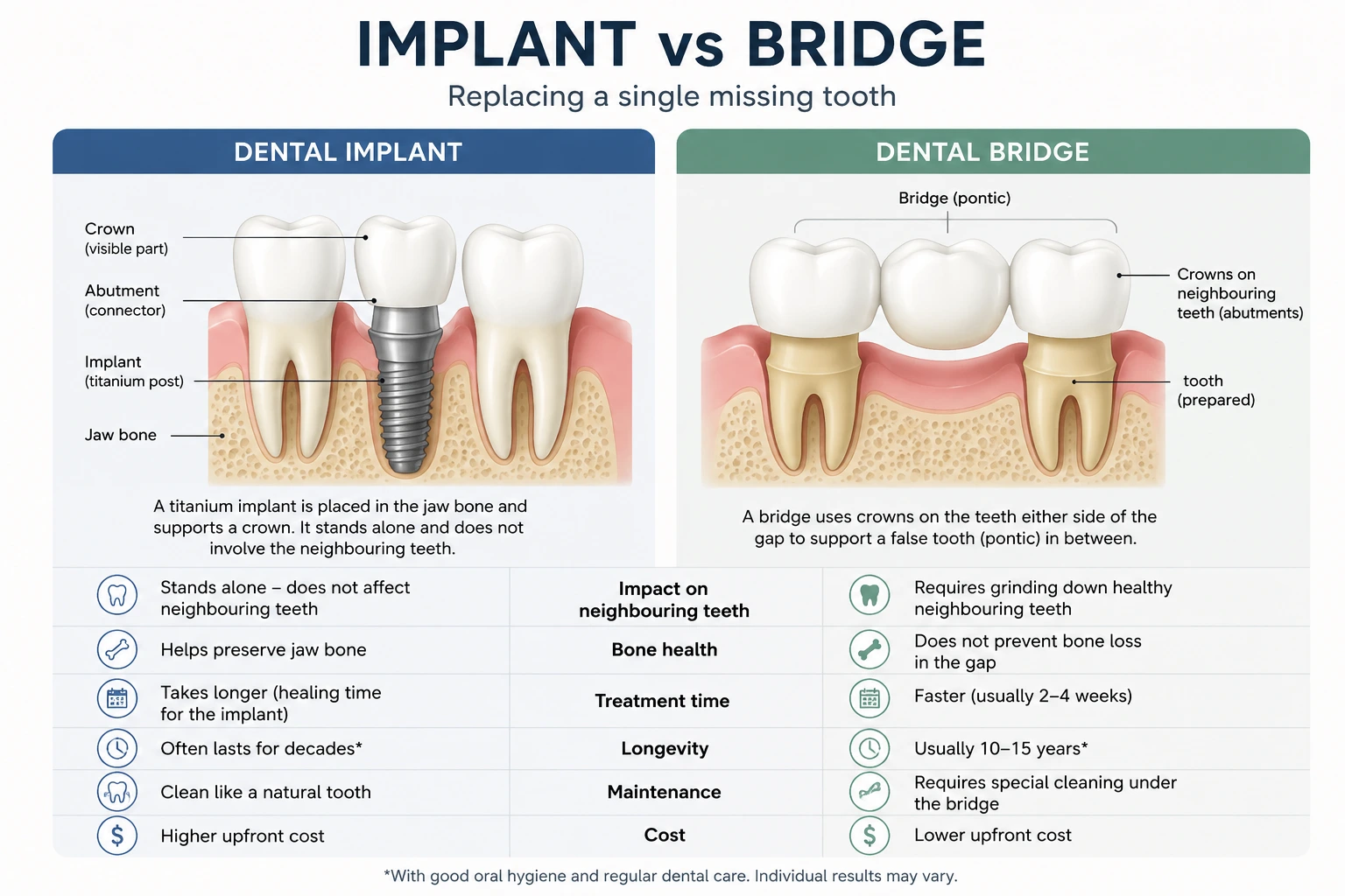 Dental implants vs bridges comparison explained in