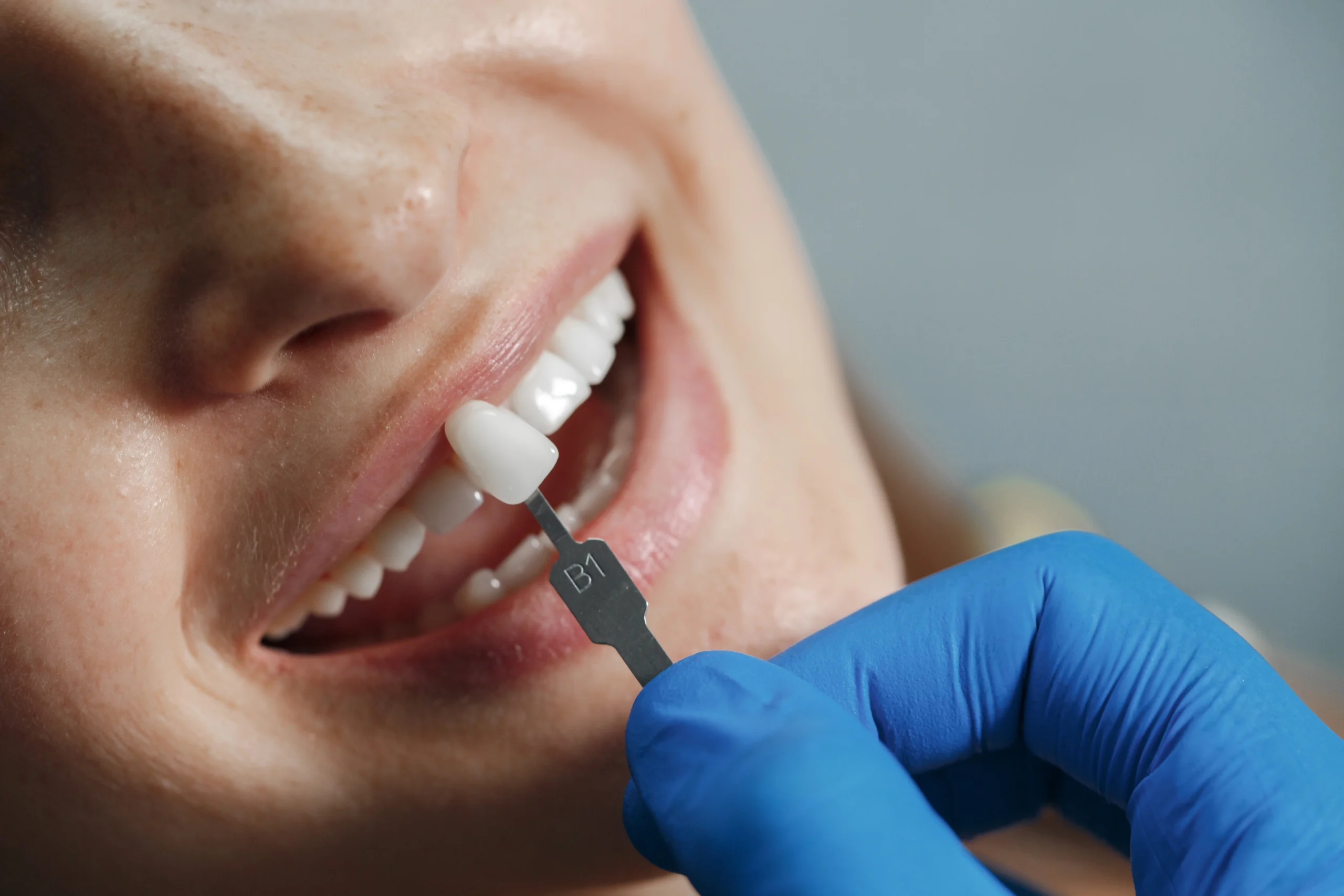 Planning porcelain veneers with a cosmetic dentist in